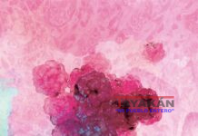 Humo de leña, factor de riesgo de cáncer de pulmón.