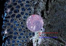 Orion, la nueva herramienta para diagnosticar el cáncer