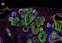 Señalan una proteína antibacteriana como posible diana contra el cáncer de páncreas.