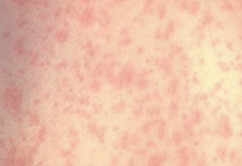 Un residente de NJ puede haber propagado sarampión en NJ Transit, los trenes PATH. Imagen del sarampión