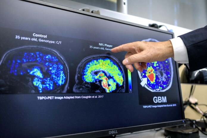 Investigación de la Universidad Internacional de Florida sobre la detección temprana de la enfermedad de Alzheimer