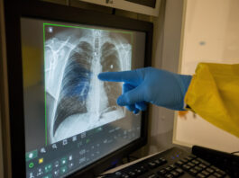 Diagnóstico temprano y prevención, pilares para mejorar salud pulmonar en América Latina